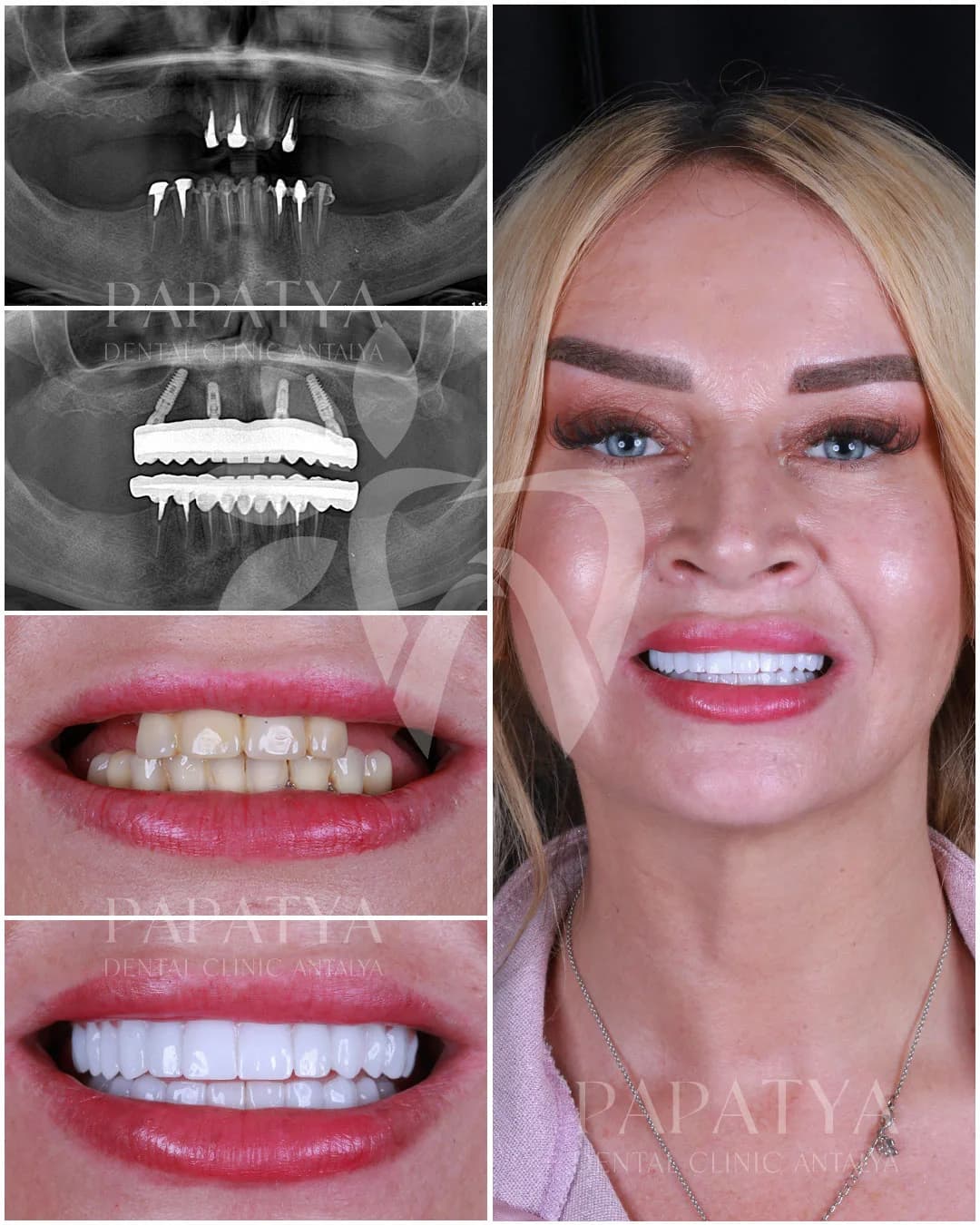 All-on-4 treatment record: panoramic X-rays before and after surgery, the mouth at the first appointment and the finished arch