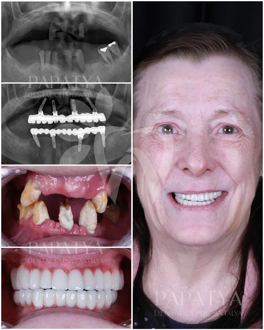 All-on-4 treatment record: panoramic X-rays before and after surgery, the mouth at the first appointment and the finished arch