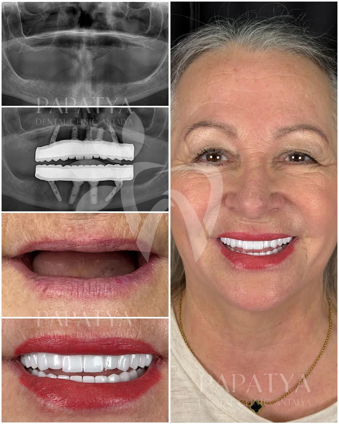 All-on-4 treatment record: panoramic X-rays before and after surgery, the mouth at the first appointment and the finished arch