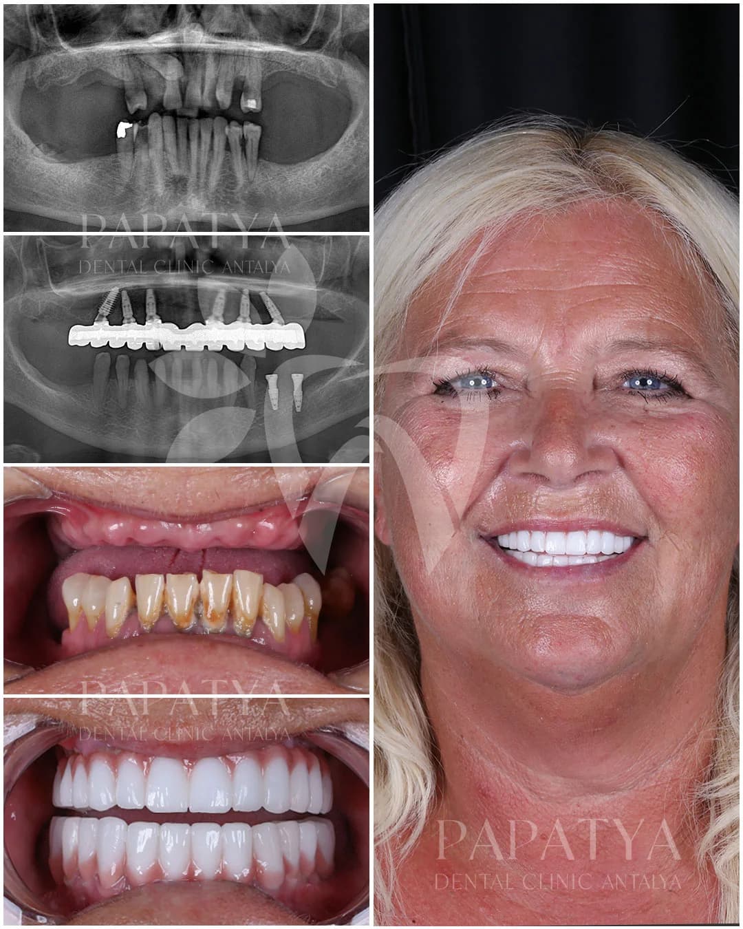 All-on-6 treatment record: panoramic X-rays before and after surgery, the mouth at the first appointment and the finished arch