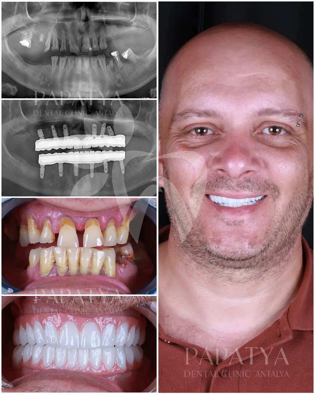 All-on-6 treatment record: panoramic X-rays before and after surgery, the mouth at the first appointment and the finished arch