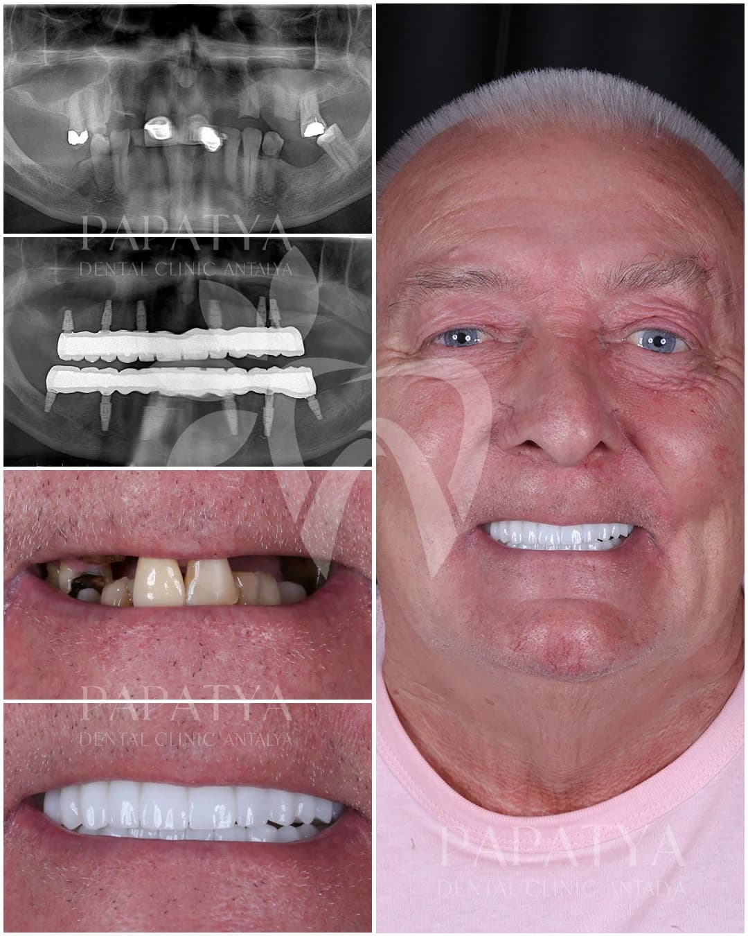All-on-6 treatment record: panoramic X-rays before and after surgery, the mouth at the first appointment and the finished arch