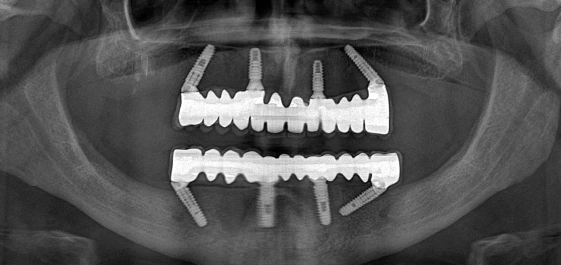 Panoramic radiograph of a completed All-on-4 case: four implants in each jaw, the rear ones placed at an angle, carrying a fixed bridge.