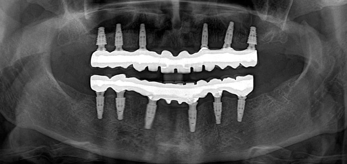 Panoramic radiograph of a completed All-on-6 case: six implants in each jaw carrying a fixed bridge.